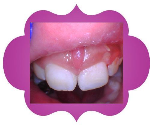 Close up of a teeth -after