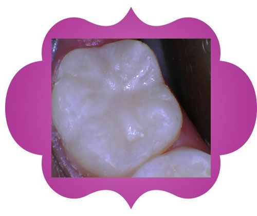 A close-up of a person's teeth - after