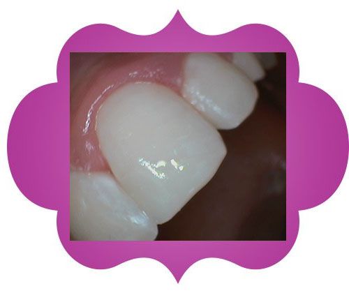 Close up of a teeth -after