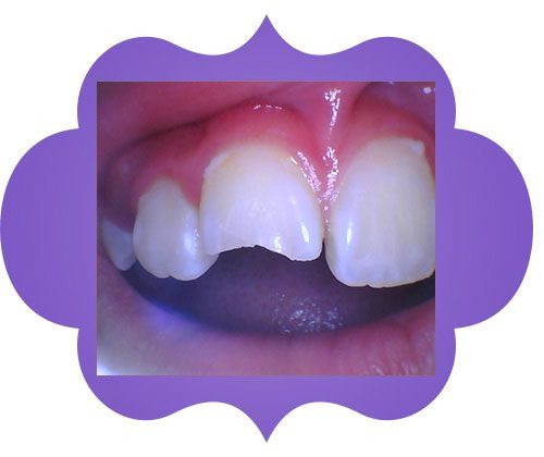 A child's teeth being check - before