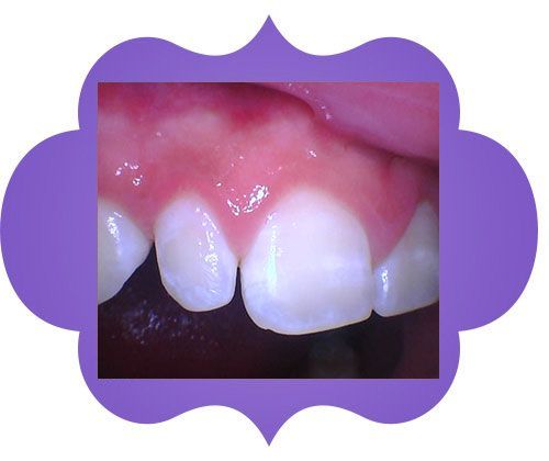 Close up of a teeth - before