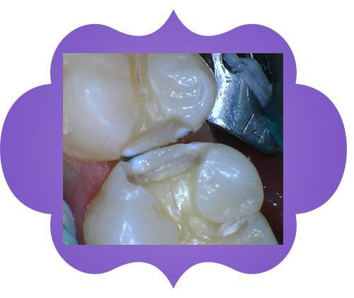 A close-up of a person's teeth - before