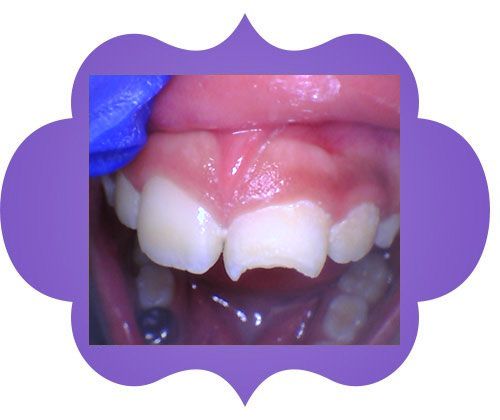 Close up of a teeth - before