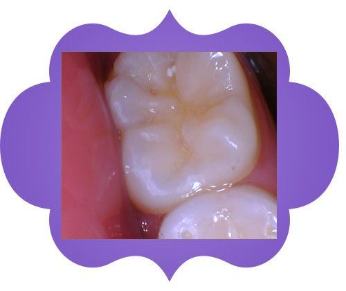 A close-up of a person's teeth - before