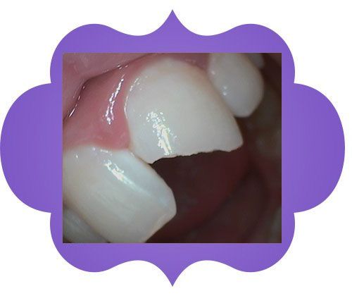 Close up of a teeth - before