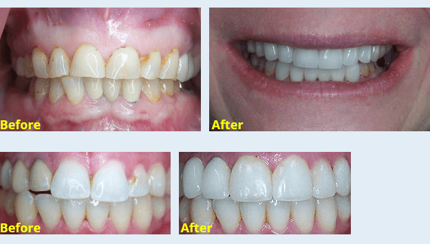Dental Crowns in Marietta GA - Kenmar Dental - Tooth Crowns