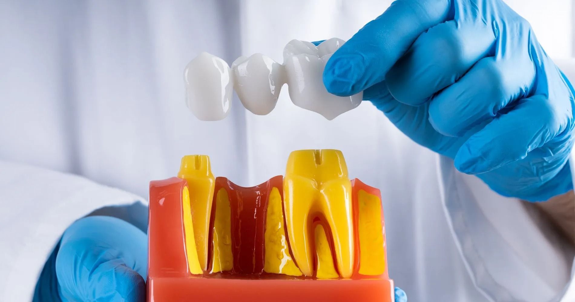Dentist holding a dental bridge above a model of teeth, showcasing the placement with blue gloved hands.