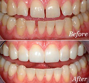 A before and after picture of a person 's teeth.