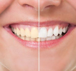 A close up of a woman 's teeth before and after whitening.