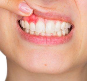 A close up of a person 's mouth with a toothache.