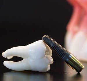 A tooth and a dental implant are on a table.