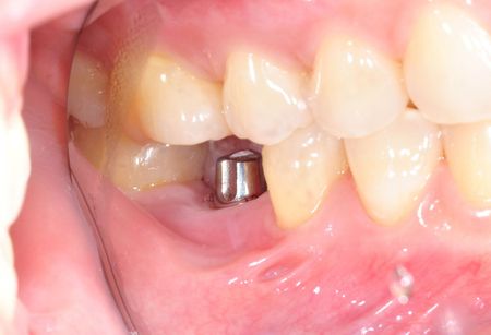 A close up of a person 's mouth with a tooth missing.