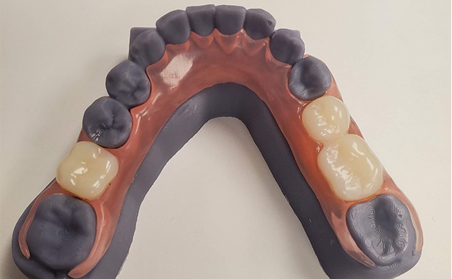 Learn More About Custom Digital Dentistry A dental model of a partial denture with purple base and tan teeth, on a white surface.