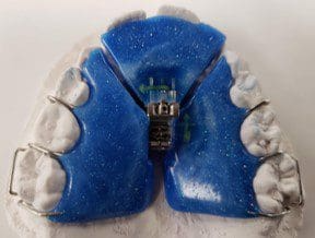 A close up of a dental brace on a model of teeth.