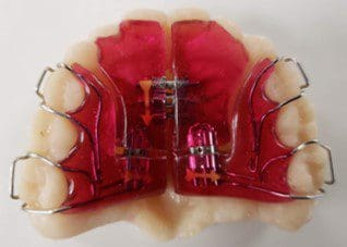 A close up of a dental brace on a model of teeth.
