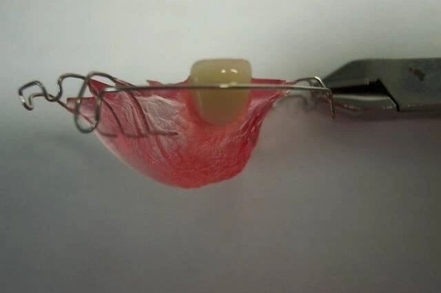 A close up of a dental retainer with a tooth in it and a pair of pliers.