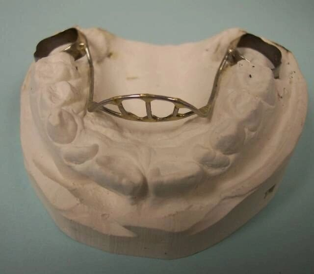 A model of a person 's mouth with a metal brace on it