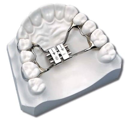 A model of a person 's teeth with a brace on it