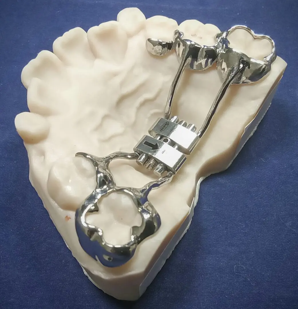 A model of a person 's teeth with a metal brace on it