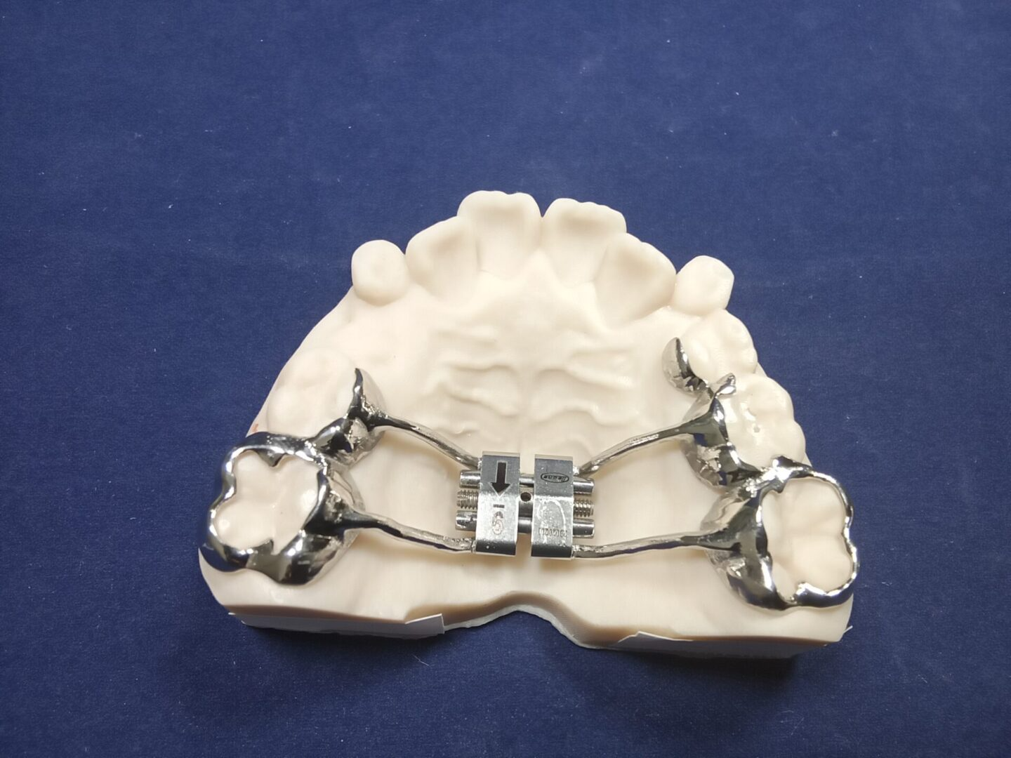 A model of a person 's teeth with braces on it