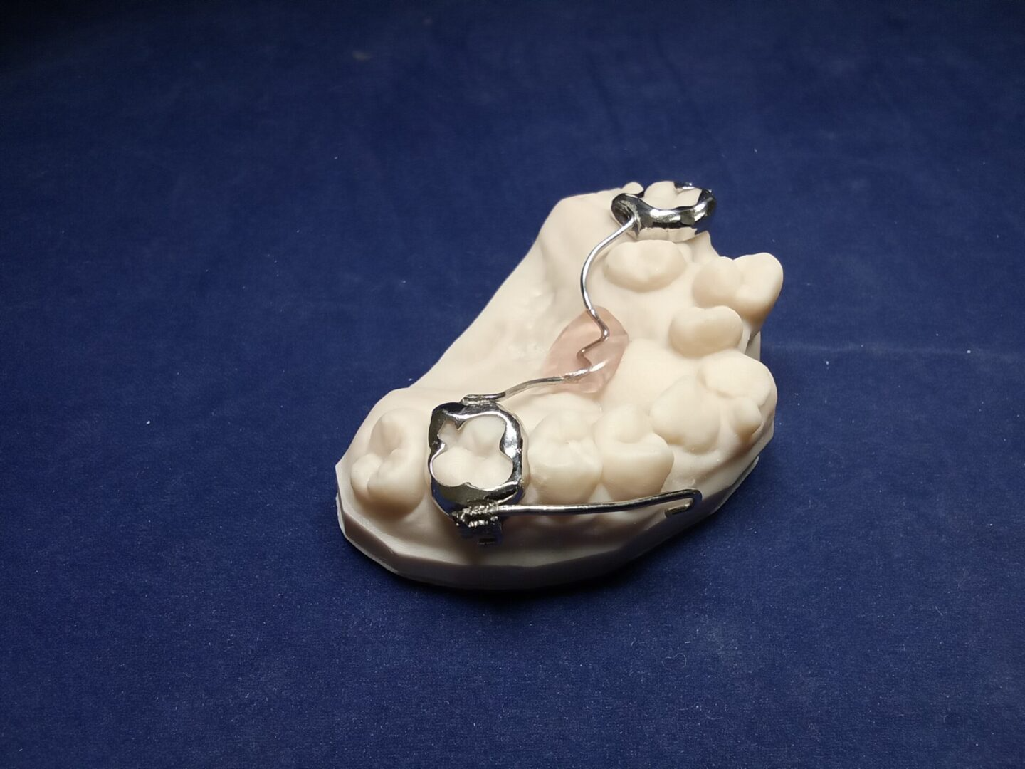 A model of a tooth with braces on it