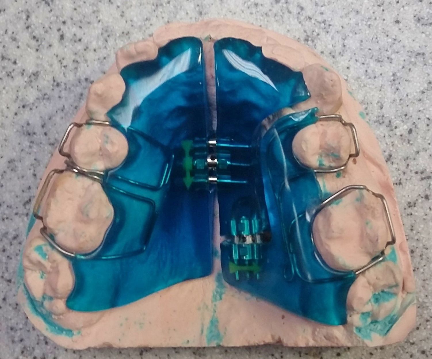 A model of a person's teeth with a blue removable expander