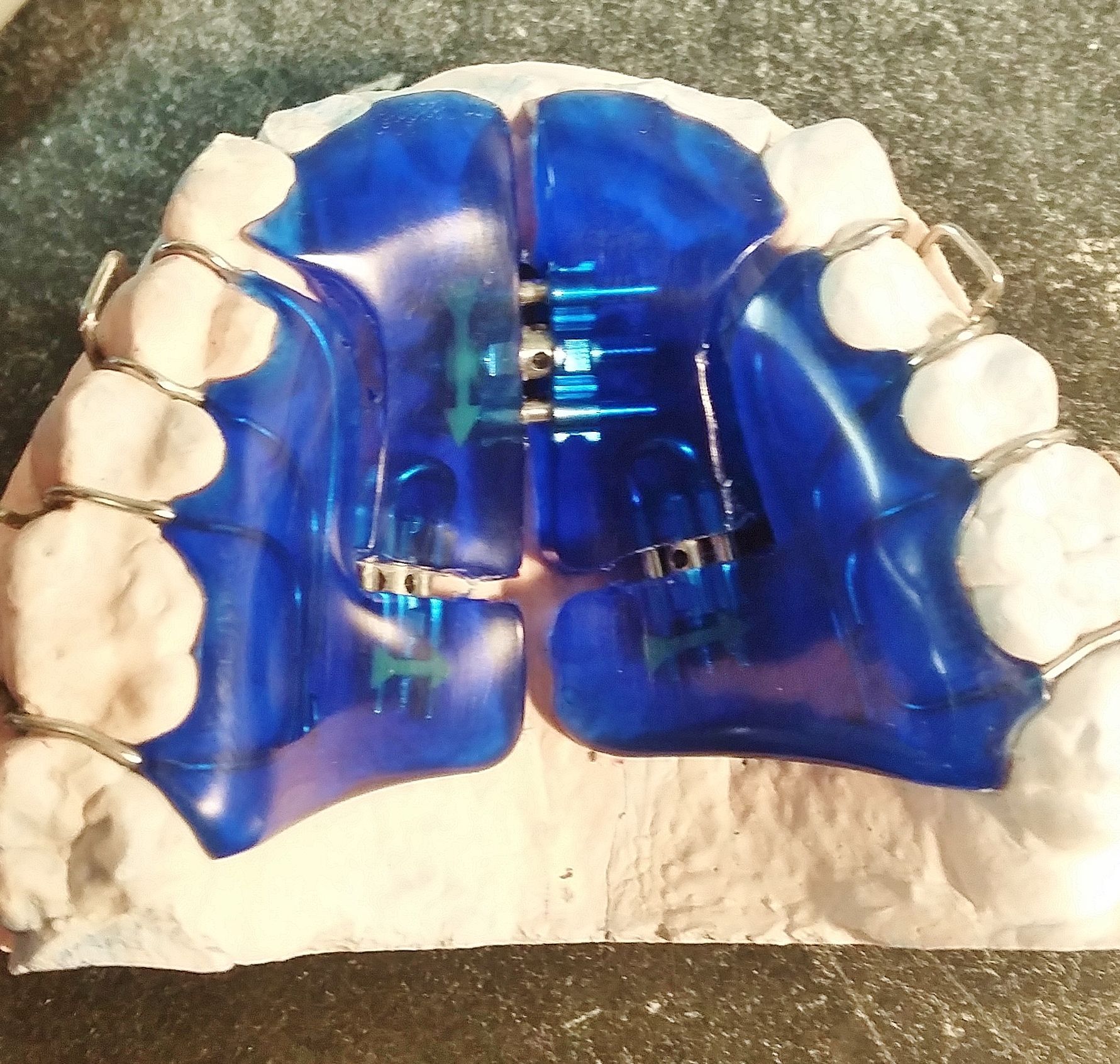 A model of a person's teeth with a blue removable expander