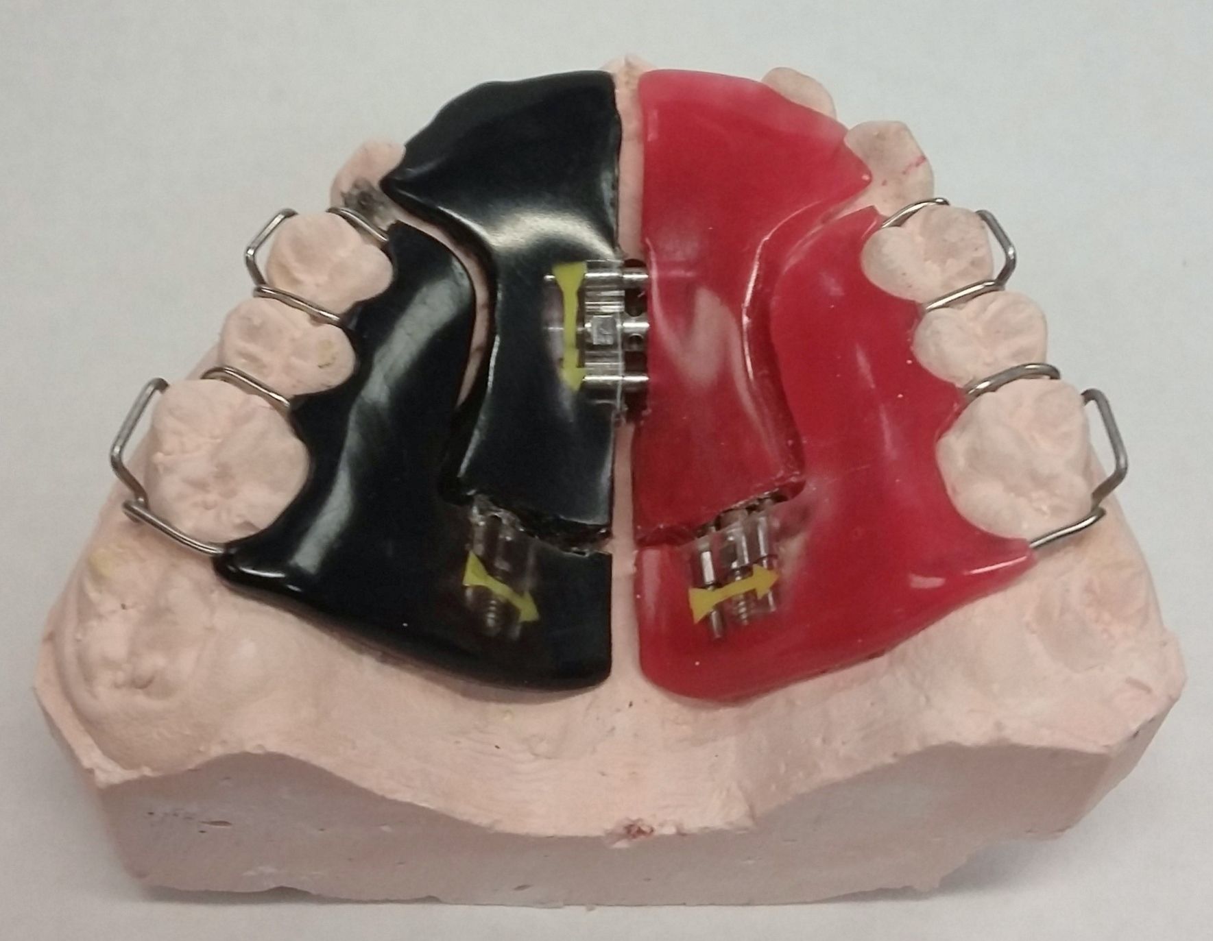 A model of a person's teeth with a black and red removable expander