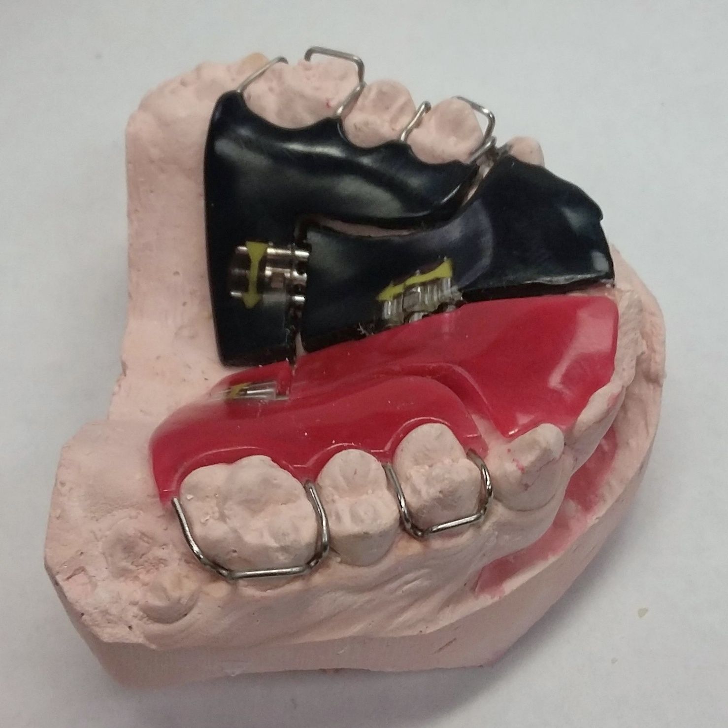 A model of a person's teeth with a black and red removable expander