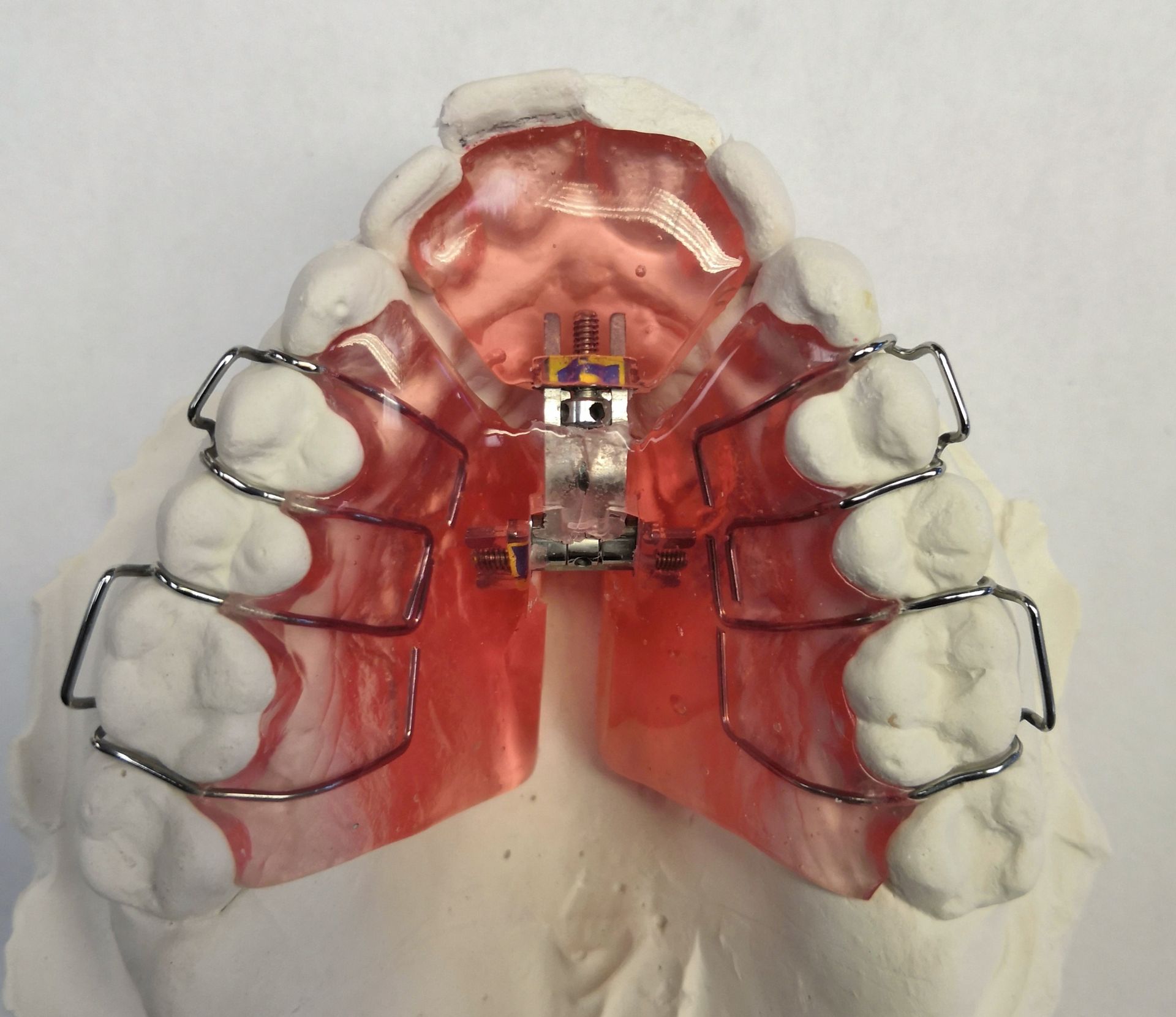 A model of a person's teeth with a red removable expander