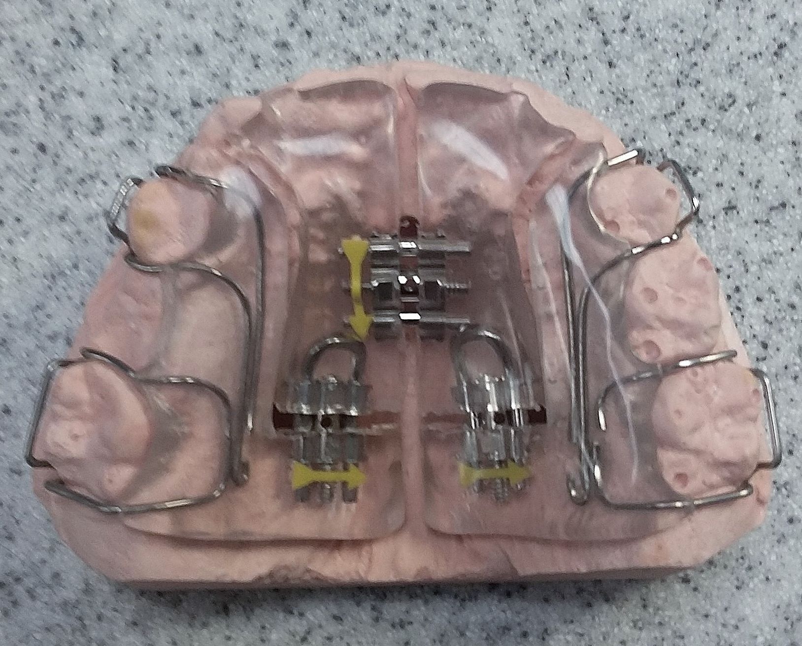 A model of a person's teeth with a transparent removable expander
