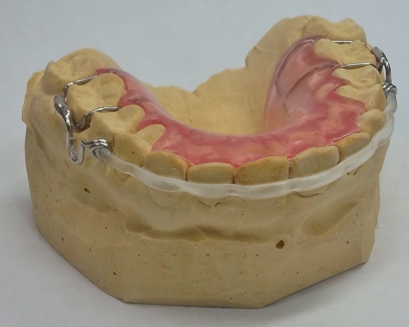A model of a mouth with braces on it