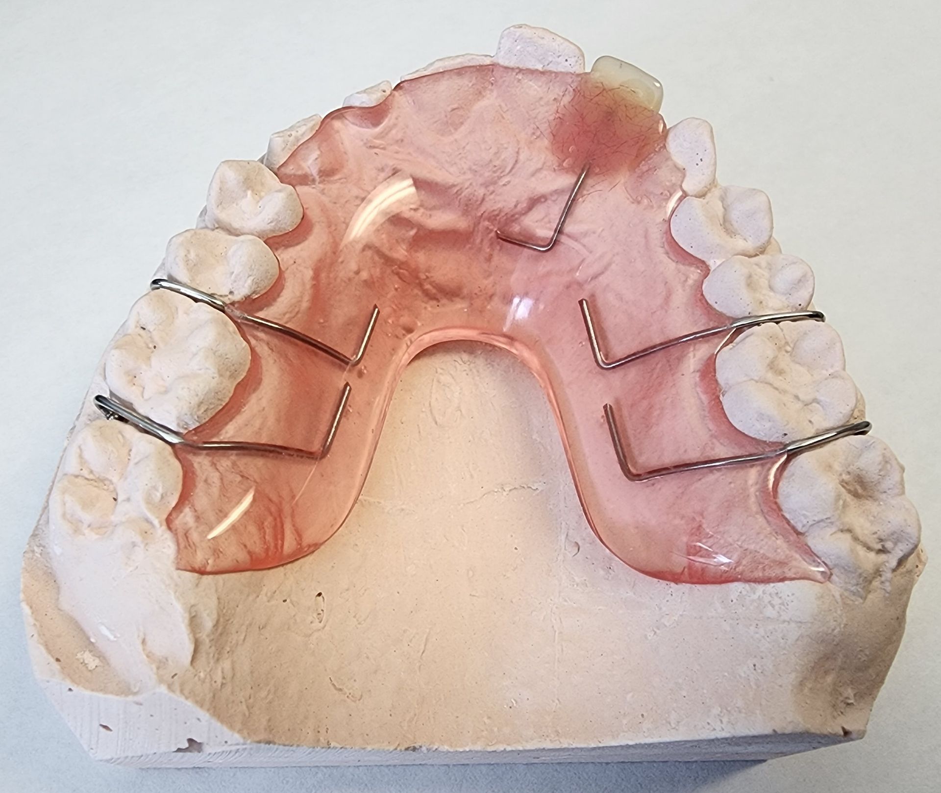 A model of a person's teeth with braces on them