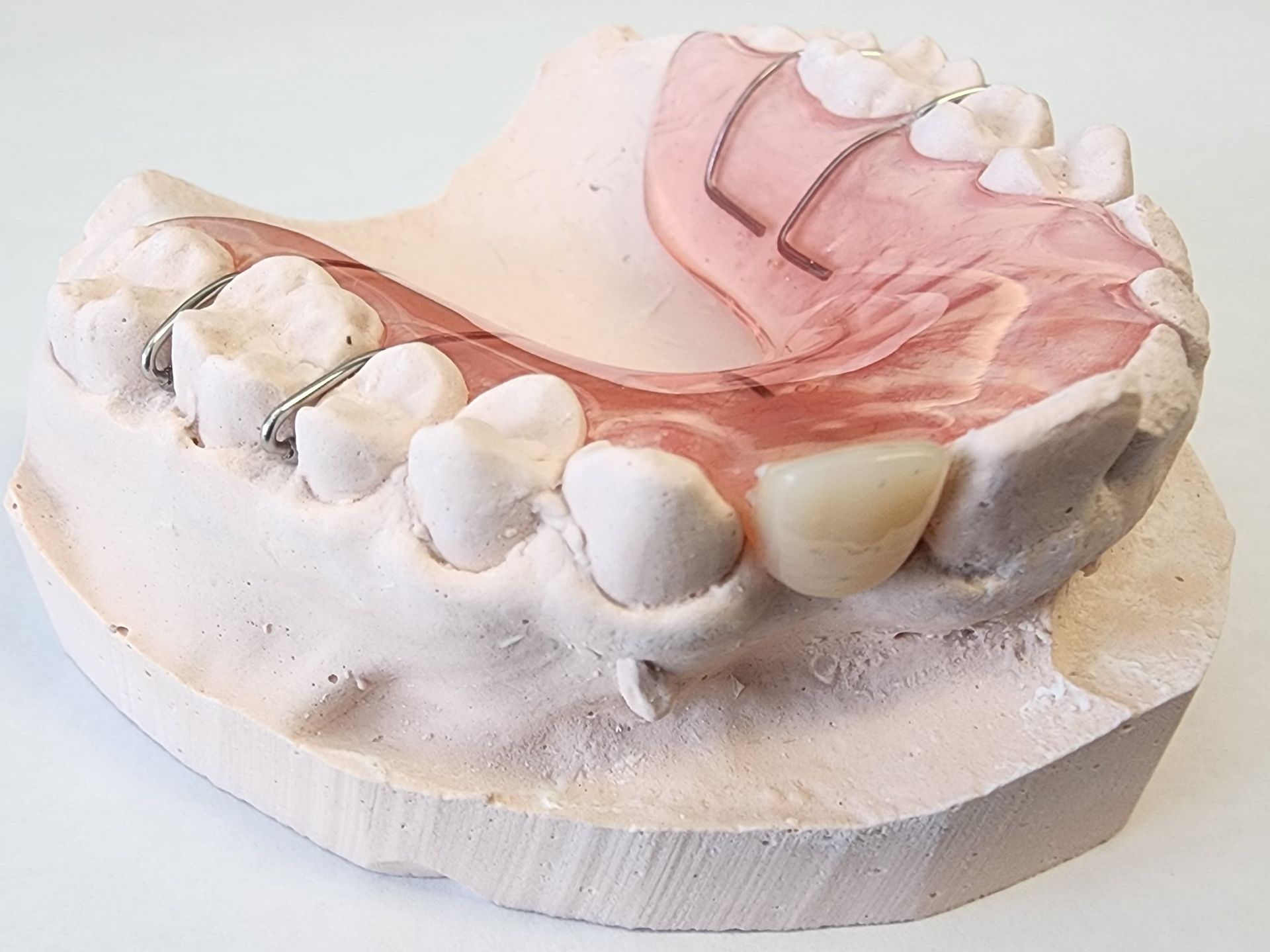 A model of a person's teeth with a partial denture.