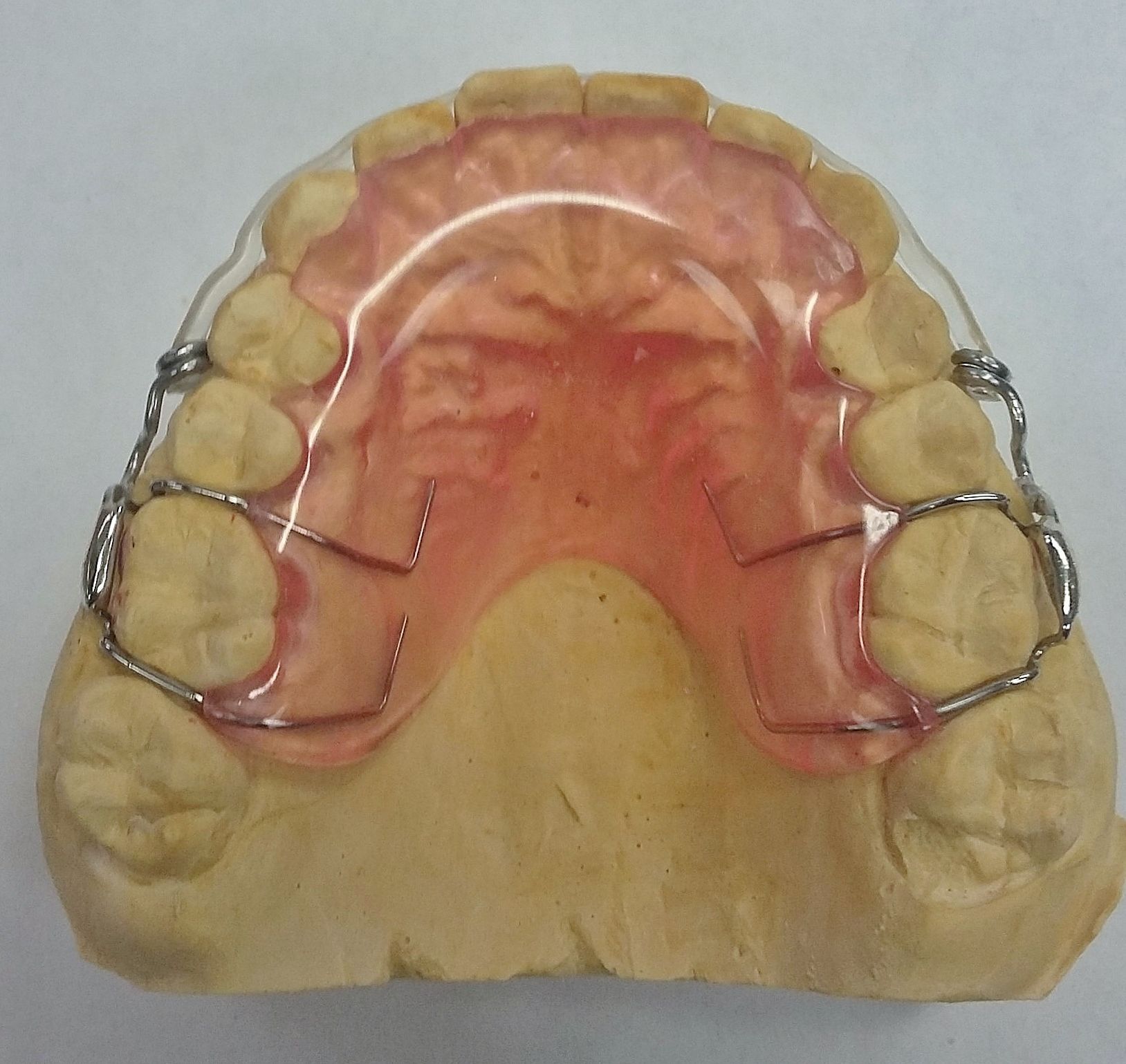 A model of a mouth with braces