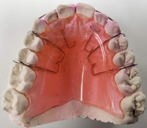 A model of a person's teeth with braces on them.