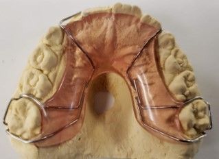 A close up of a dental model with a retainer on it.
