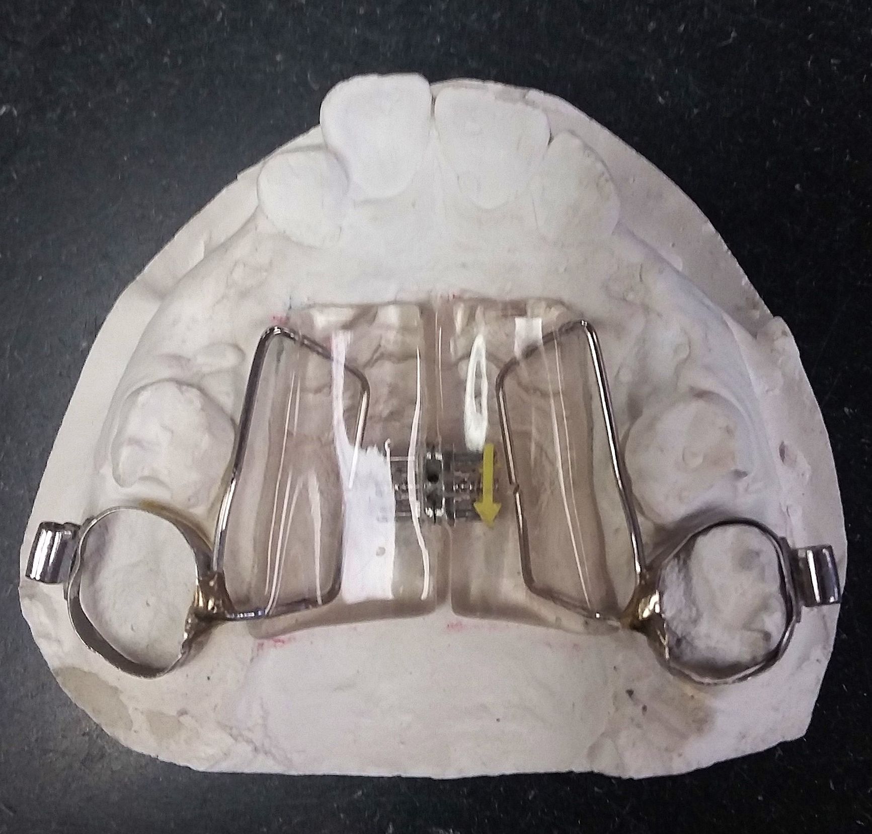 A model of a mouth with a HAAS palatal expander