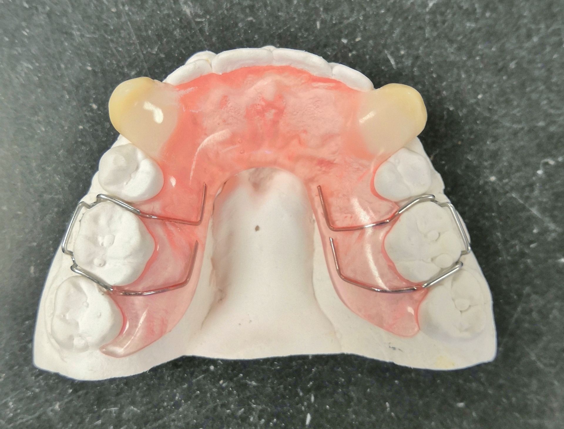 A model of a lower jaw with a partial denture on it