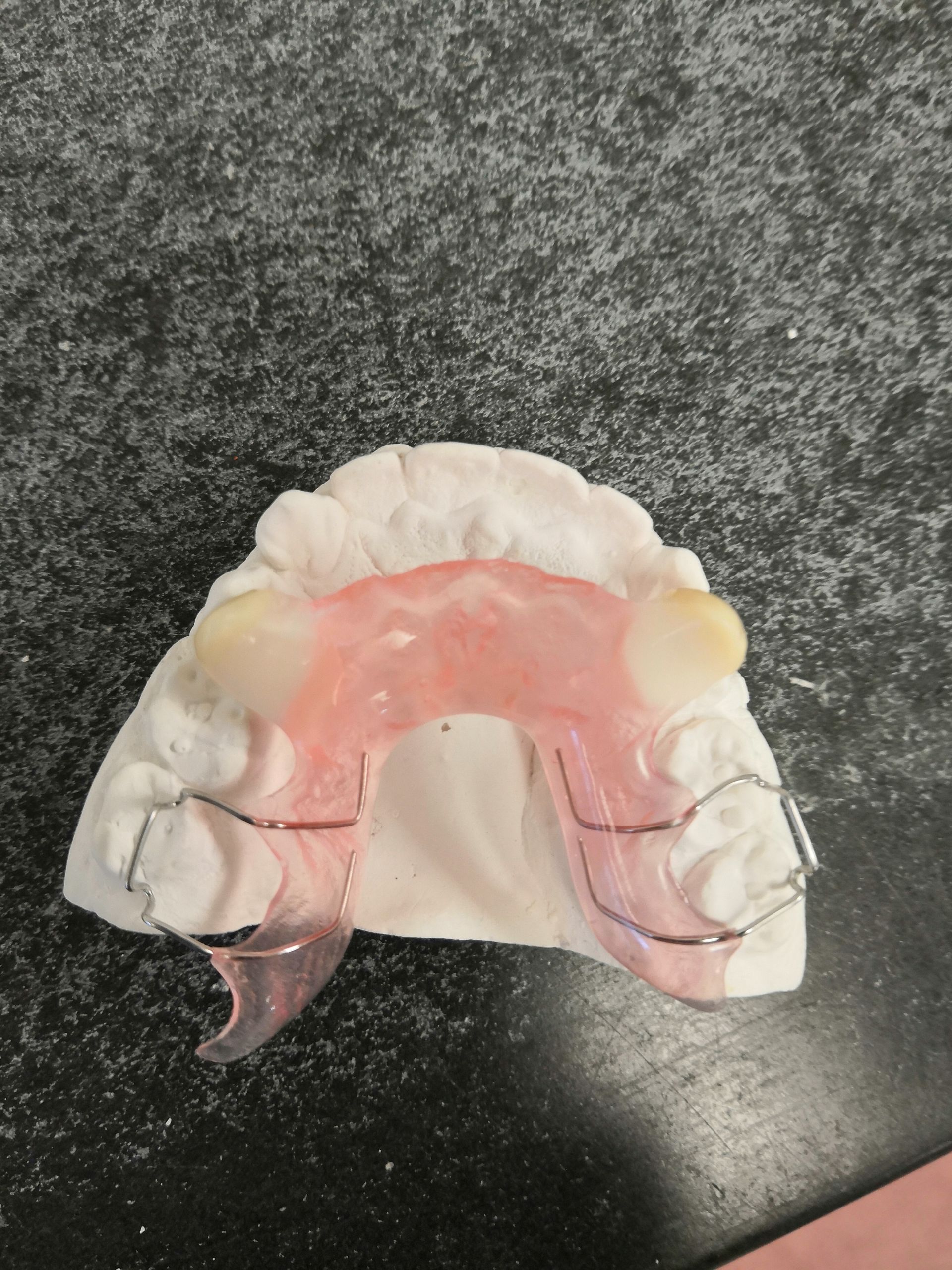 A model of a tooth with braces on it