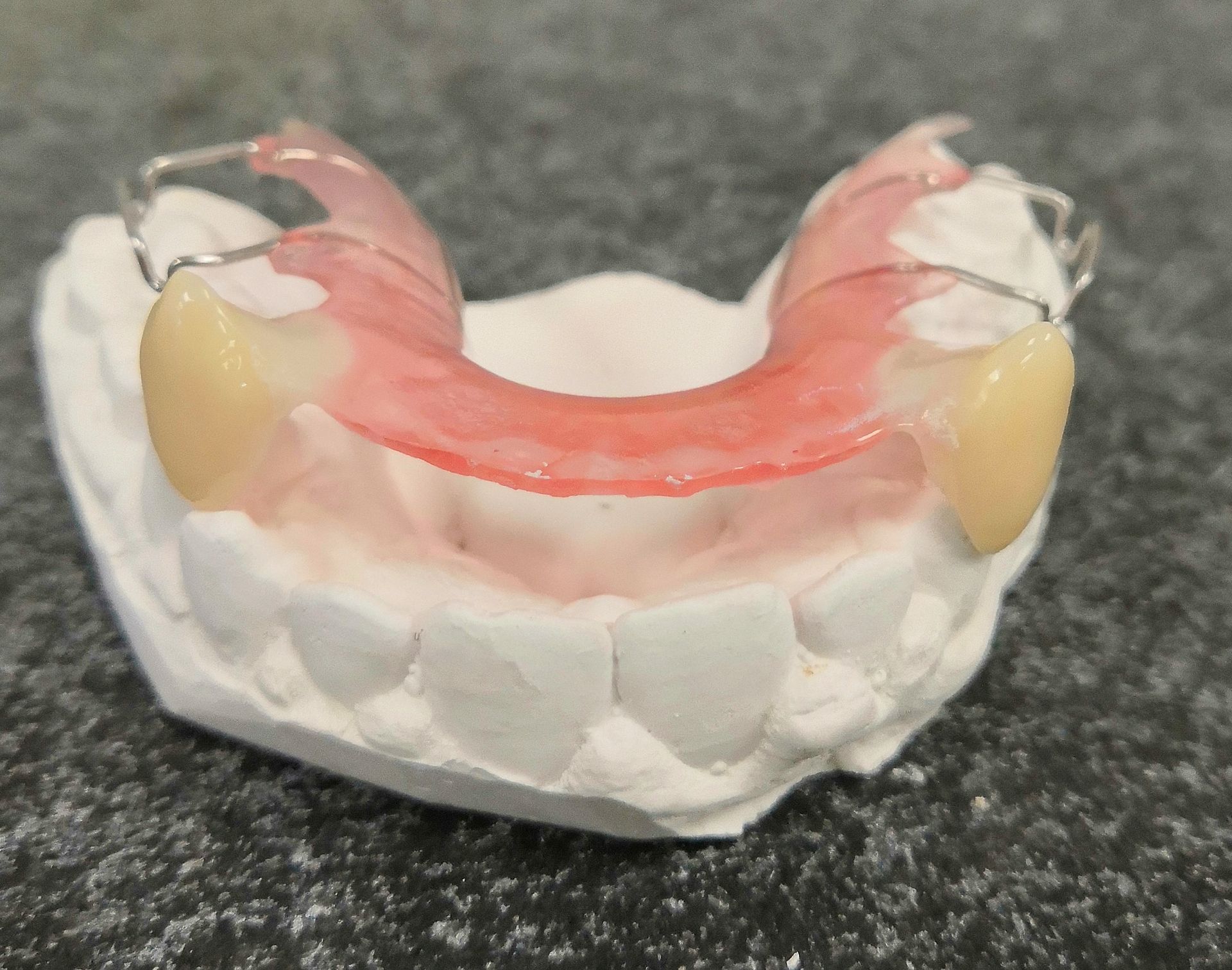 A denture is sitting on top of a model of a person's teeth.