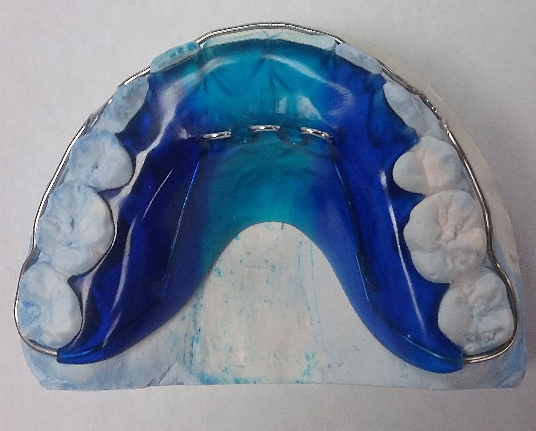 A model of a person's teeth with blue braces