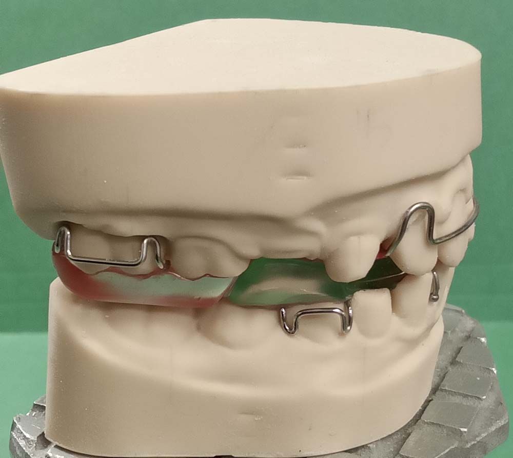 A model of a person's teeth with braces on them
