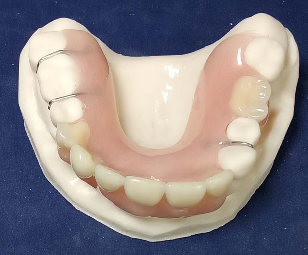A model of a denture with braces on it