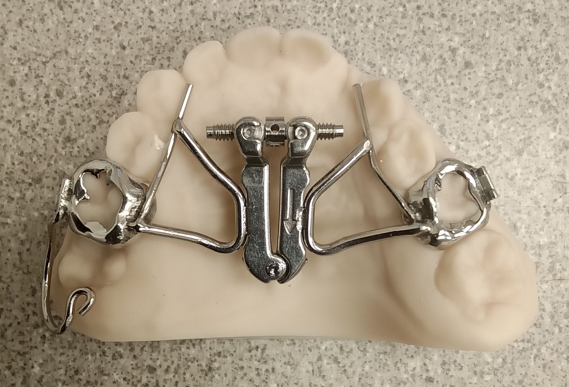A model of a tooth with a metal brace on it
