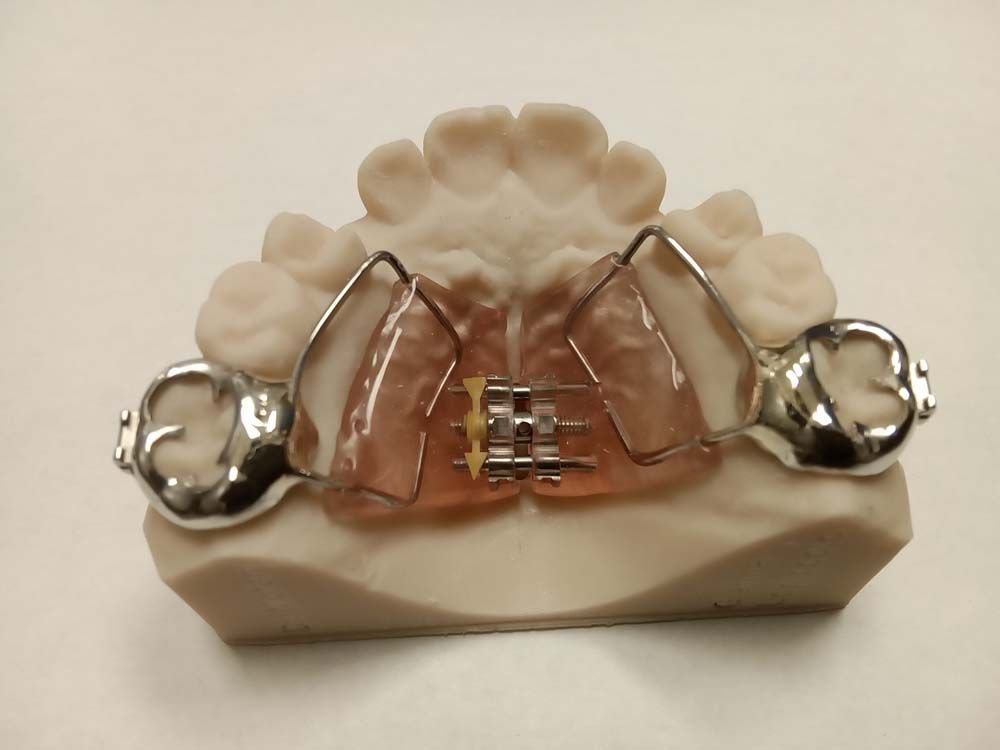 A model of a tooth with braces on it