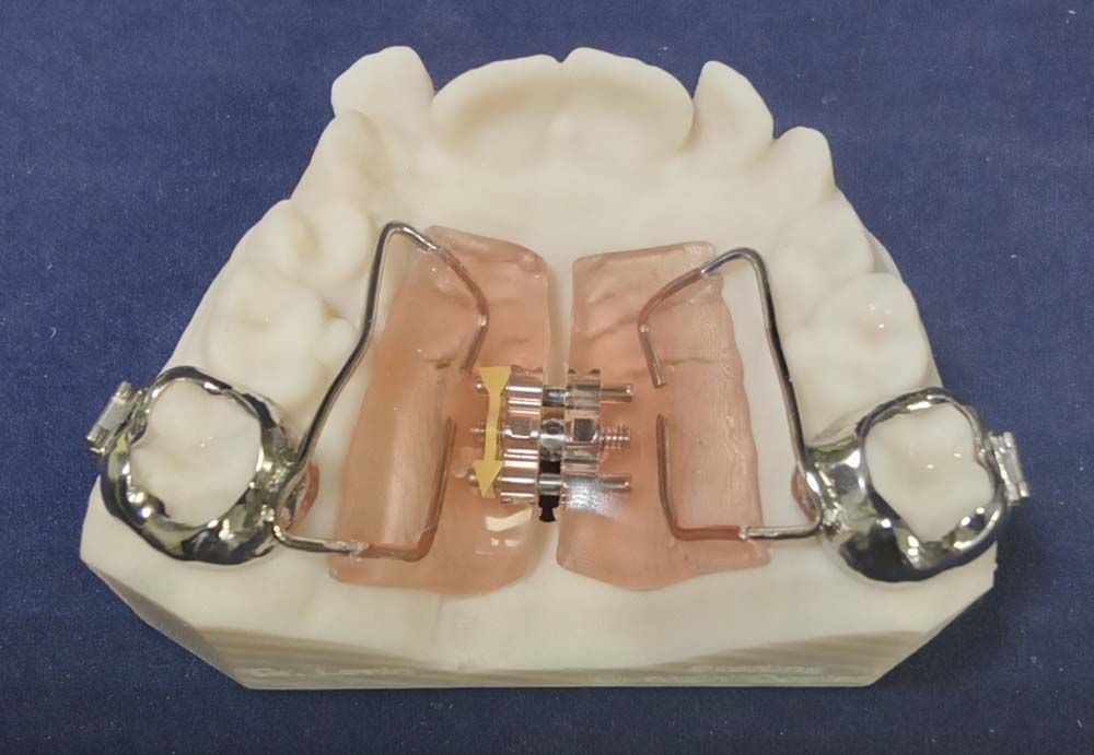 A model of a person's teeth with braces on it