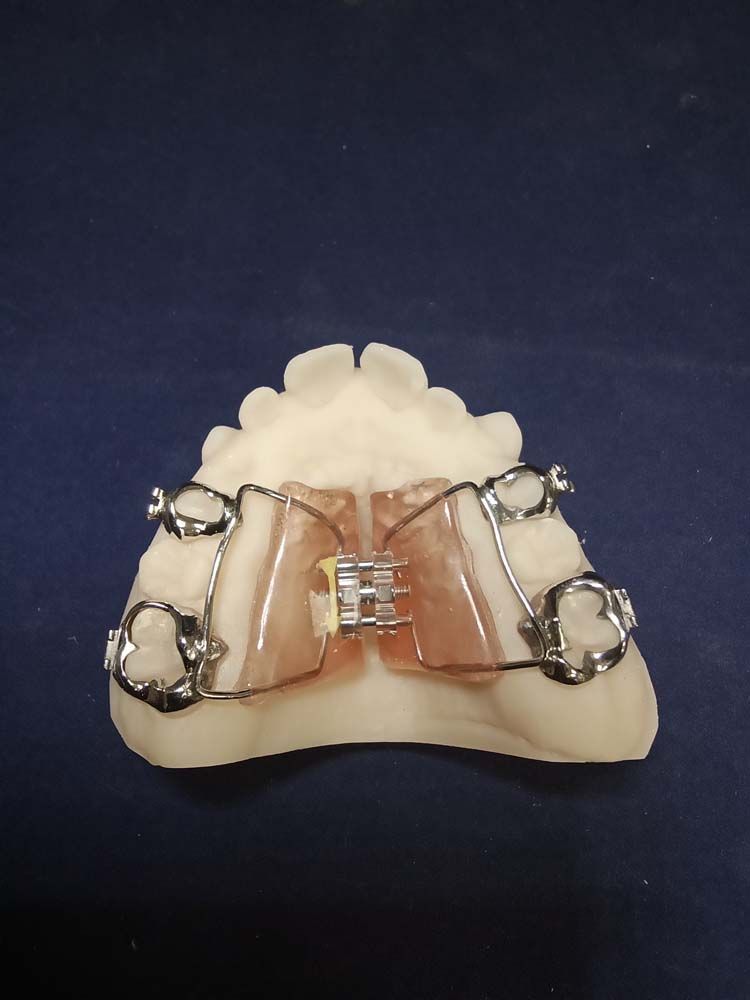 A model of a tooth with braces on it