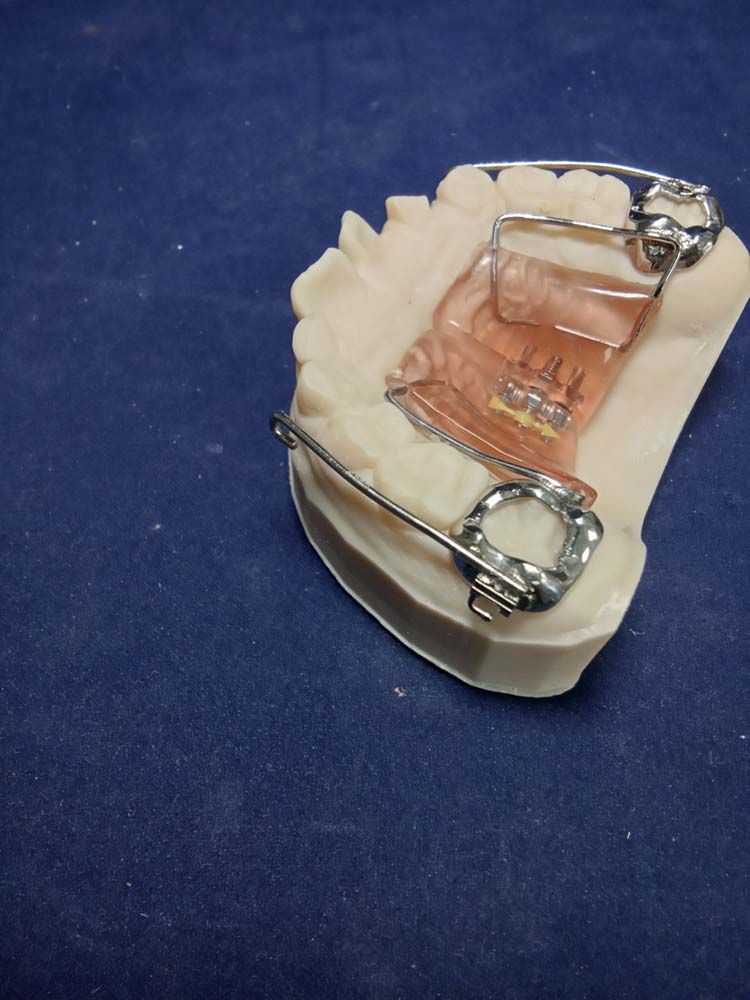 A model of a mouth with braces on it