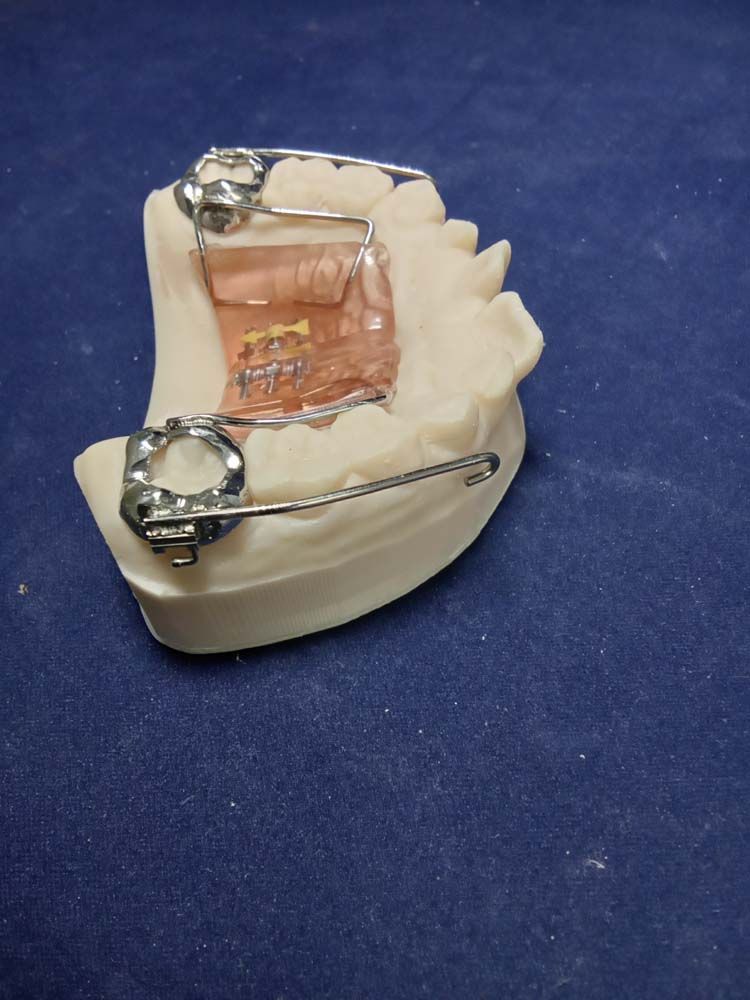 A model of a tooth with braces on it
